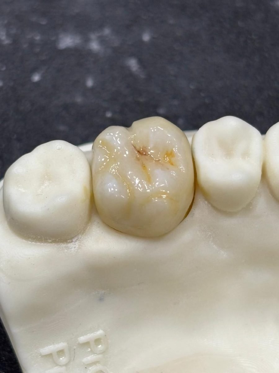 Coroa caracterizada posicionada em modelo impresso 3D Protética Dente