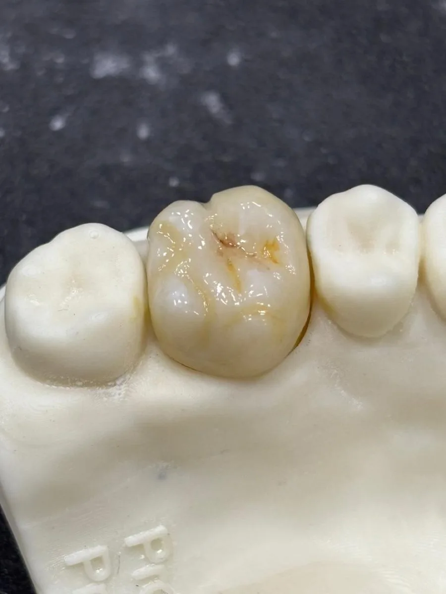 Coroa em modelo impresso 3D